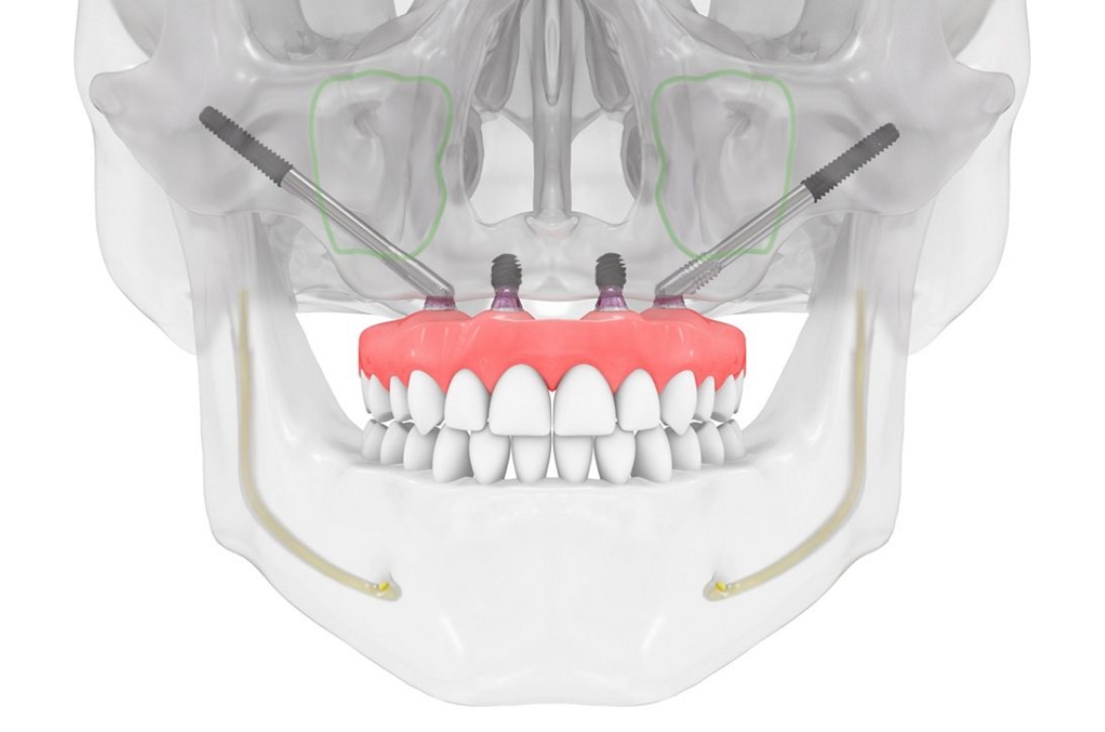 Implantes Zigomáticos