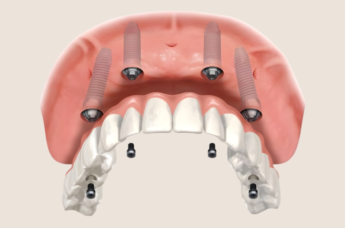 Implantes