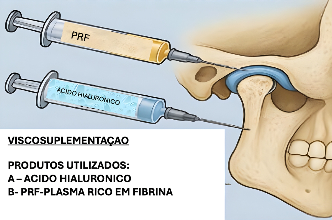 Viscossuplementação