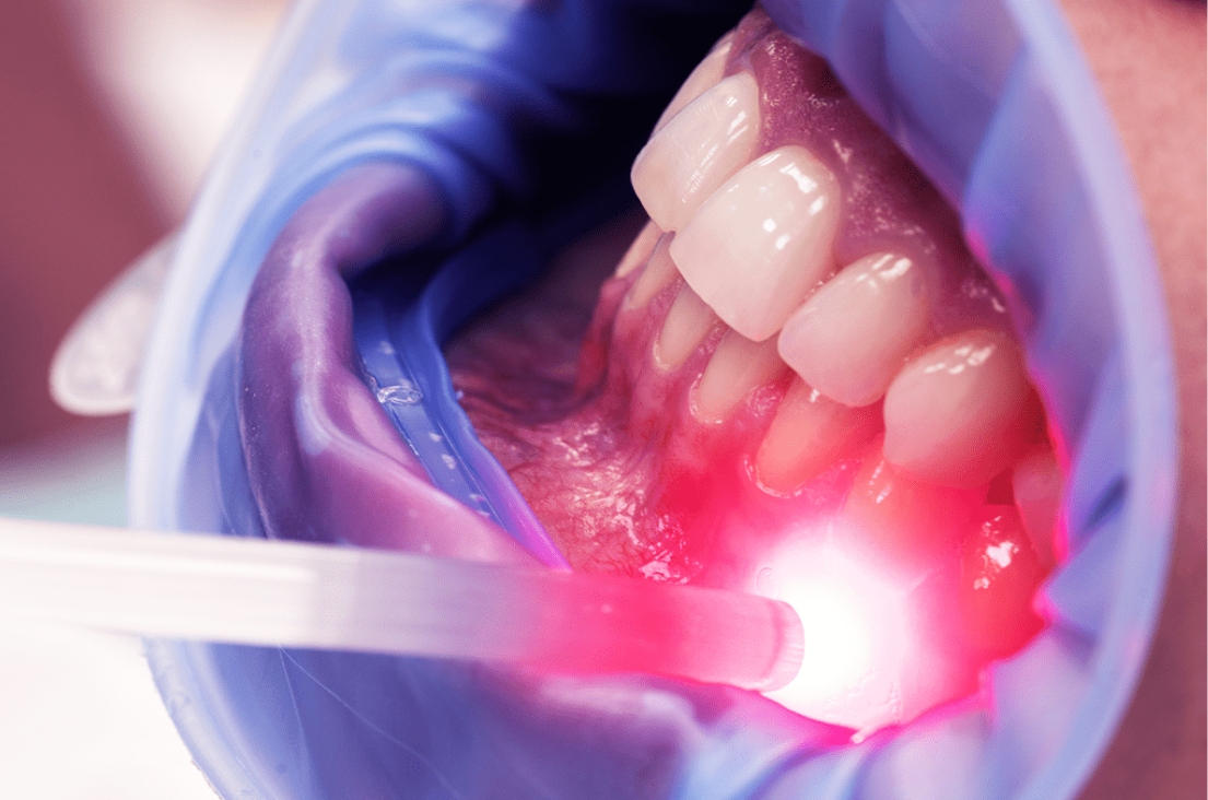 laserterapia